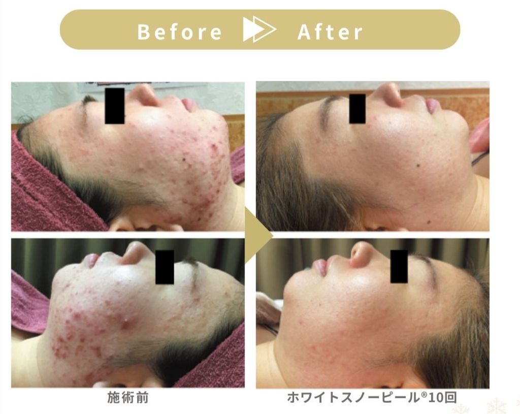 クリニック監修ピーリング