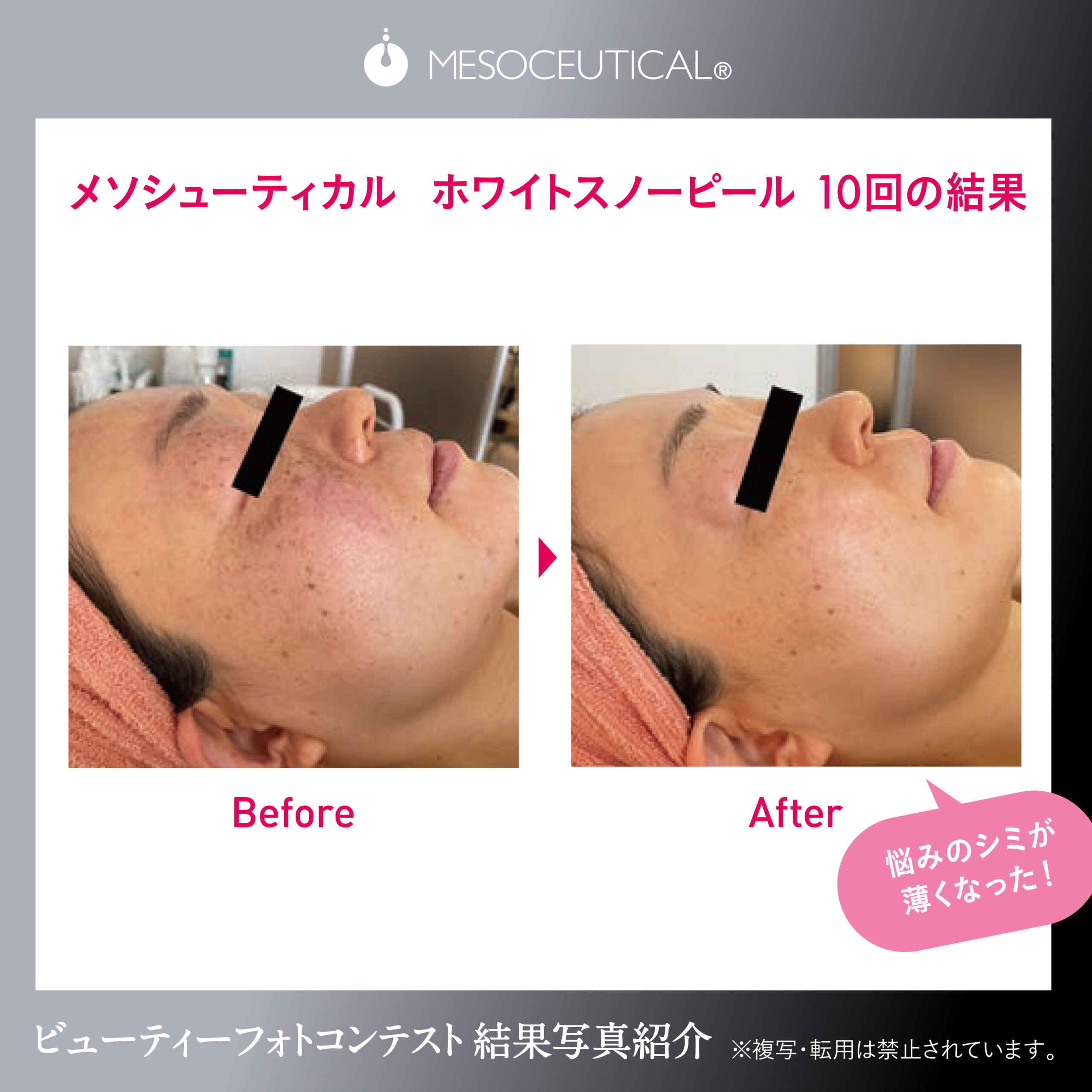 美容クリニック監修☆ホワイトスノーピール